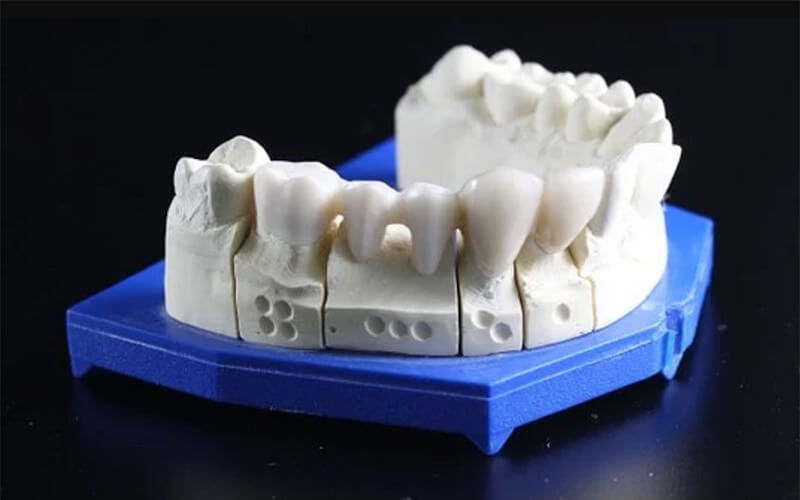 Studio Dentistico Oriolo | Dentista a Lido di Ostia | Protesi Dentale Fissa