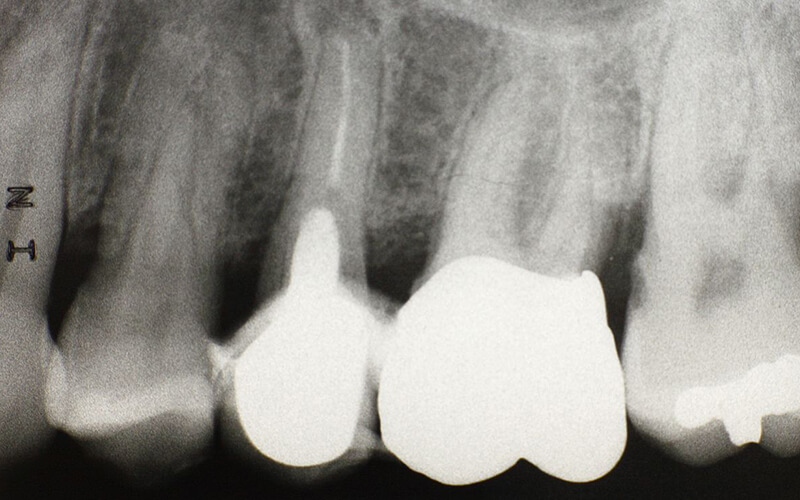 Studio Dentistico Oriolo | Dott.ssa Carmen oriolo Odontoiatra Lido di Ostia | Radiografia Endorale