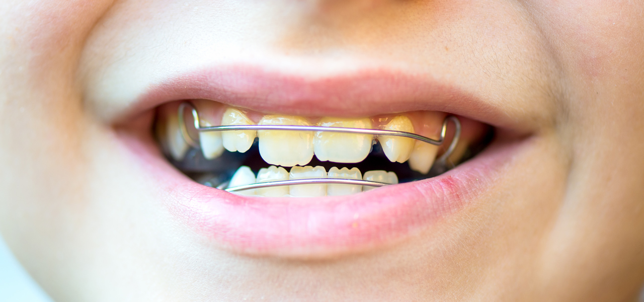 Le domande più frequenti sul trattamento ortodontico con