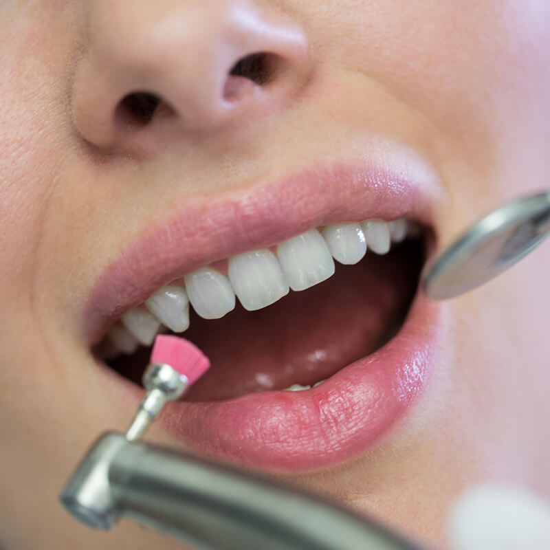 Studio Dentistico Oriolo | Ostia Lido | Tartaro e Placca Nemici Dei Denti | Igiene Dentale Professionale