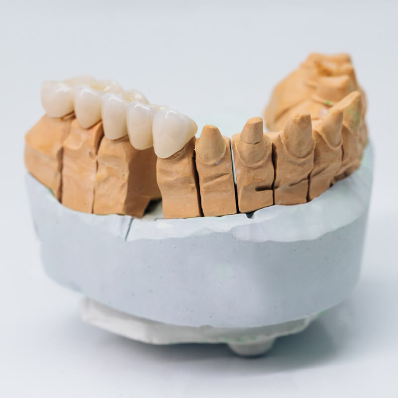 Studio Dentistico Oriolo | Ostia Lido | Protesi Fissa | Ceramica Metal Free