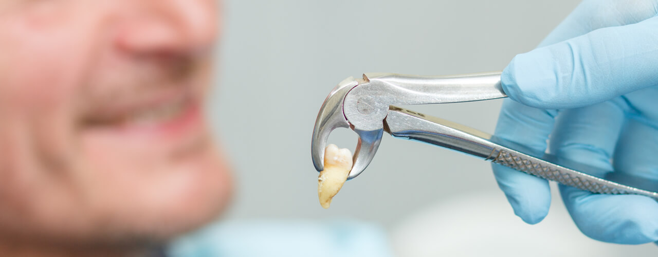 Studio Dentistico Oriolo | Ostia Lido | Denti Del Giudizio | Estrazione