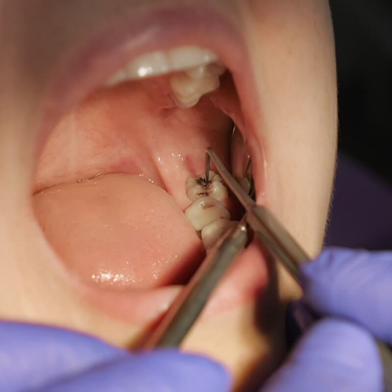 Studio Dentistico Oriolo | Lido di Ostia | Anestesia Dentale | Carie