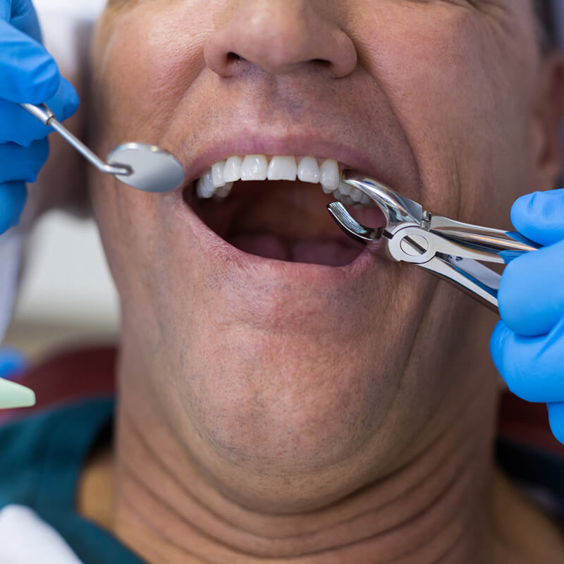 Studio Dentistico Oriolo | Lido di Ostia | Anestesia Dentale | Estrazione Denti