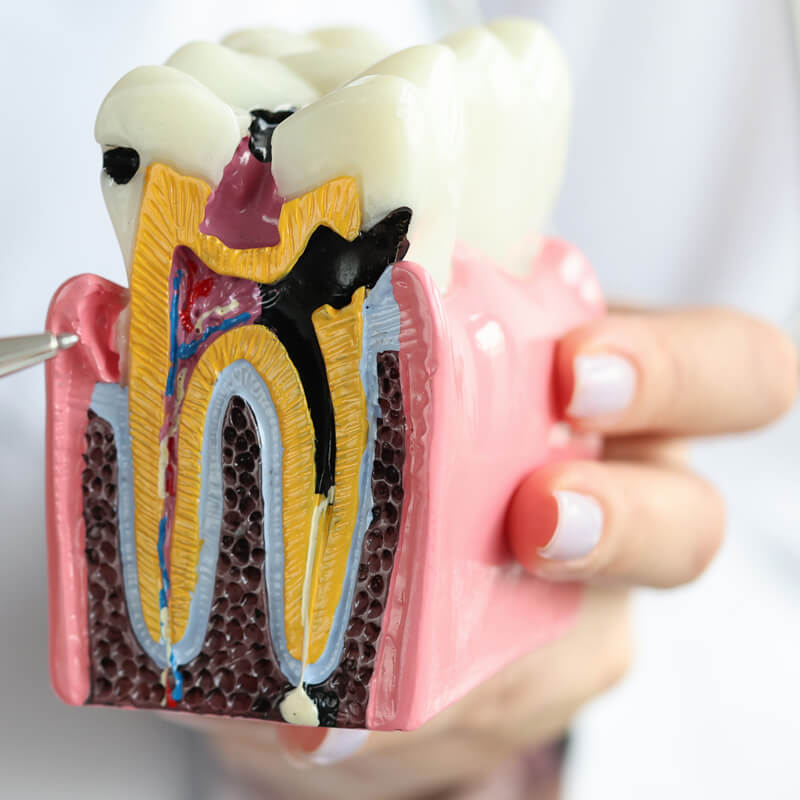 Studio Dentistico Oriolo | Lido di Ostia | Anestesia Dentale | Pulpite